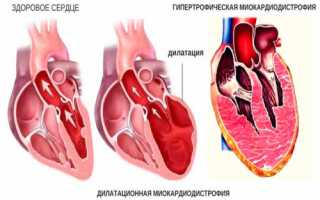 Что такое дистрофия миокарда: причины заболевания и методы лечения