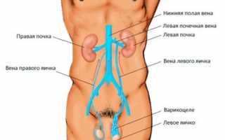 Что такое левостороннее варикоцеле и как его лечить