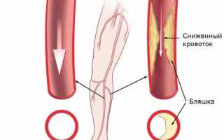 Облитерирующий атеросклероз сосудов нижних конечностей