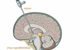 Что такое шунтирование сосудов головного мозга и как устраняют нарушение мозгового кровотока