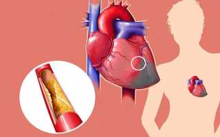 Острая коронарная недостаточность: причины, симптомы и лечение