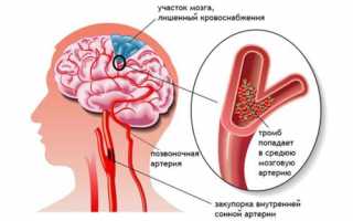 Лечение инсульта народными средствами: самые эффективные, восстановление, как лечить