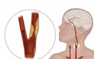 Стеноз сонной артерии: причины, симптомы, как и чем лечить