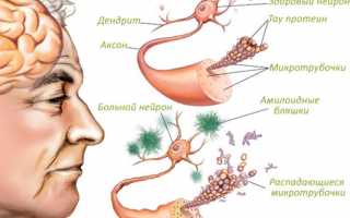 Описание признаков и симптомов болезни Альцгеймера