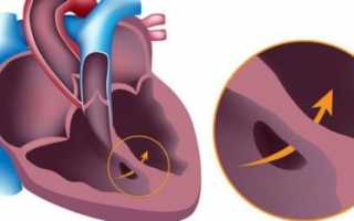 Стеноз аортального клапана: симптомы, причины, лечение, профилактика