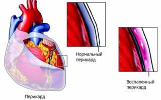 Все риски хронического перикардита