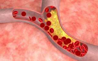 Как избавится от бляшек в сосудах шейного отдела
