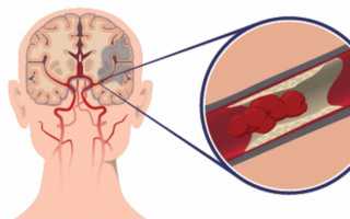 Ишемический инсульт: чем опасен, прогноз для жизни