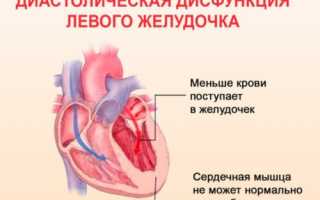 Диастолическая дисфункция левого желудочка: типы, признаки, лечение