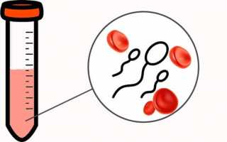 Причины возникновения и методы лечения крови в сперме