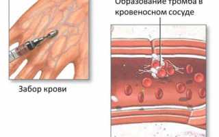 Плохо сворачивается кровь: причины, чем опасно и что делать