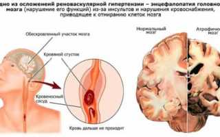 Что такое энцефалопатия смешанного генеза: причины и методы лечения