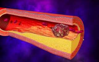 Причины возникновения тромбов в сосуде и способы избежать их отрывания