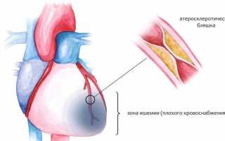 Причины, симптомы и лечение ишемической болезни сердца