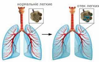 Одышка у взрослых и детей: причины, виды и признаки