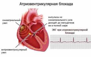 Атриовентрикулярная блокада: что это такое, причины, методы лечения