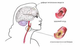 Симптомы атеросклероза сосудов головного мозга, лечение и профилактика