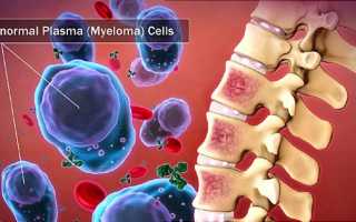Миеломная болезнь крови: анализ заболевания
