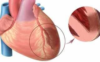 8 признаков инфаркта миокарда