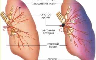 Причины развития острого и хронического лёгочного сердца