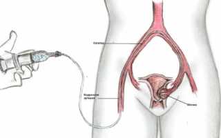 Эмболизация маточных артерий при миоме матки