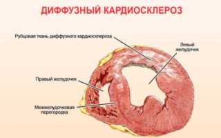 Что такое диффузный кардиосклероз: причины, симптомы и лечение