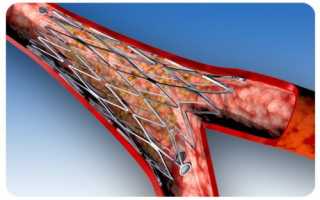 Стенты для коронарных сосудов — разновидности, способы установки, показания