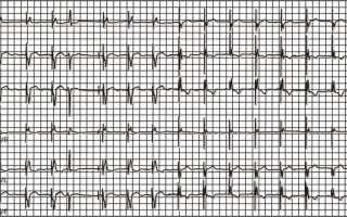 Суправентрикулярная экстрасистолия: классификация, причины, диагностика и лечение