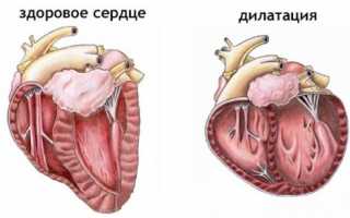 Что такое гипертрофия левого предсердия сердца