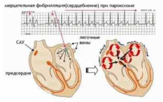 Что такое пароксизмальная мерцательная аритмия и методы лечения