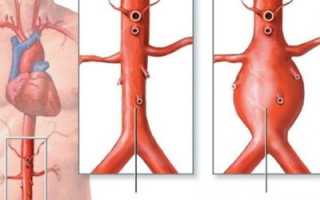 Что такое уплотнение аорты сердца и как лечить заболевание