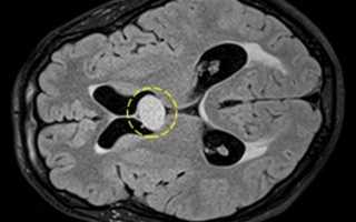 Киста головного мозга: причины, симптомы и лечение