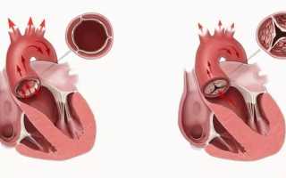 Диагноз «порок сердца», его симптомы, формы и последствия