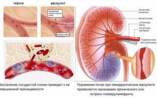 Васкулит: симптомы и лечение, что за болезнь