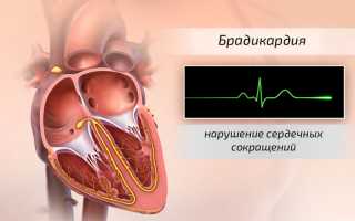 Брадикардия у беременных: риски и лечение