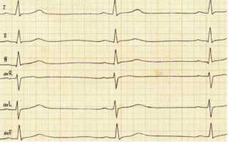 Синусовая аритмия сердца: что это такое, причины, лечение