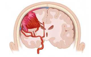 Ангиома головного мозга: симптомы, причины, лечение, профилактика