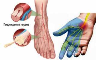 Причины возникновения полинейропатии нижних конечностей и ее лечение
