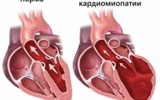 Что такое алкогольная кардиомиопатия: симптомы, лечение