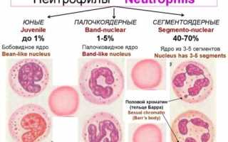 Что такое нейтрофилез: причины заболевания и методы лечения