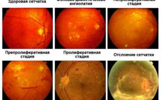 Ангиопатия сетчатки обоих глаз: причины, симптомы и лечение