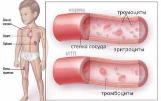 Аутоиммунная и иммунная тромбоцитопения: симптомы и лечение