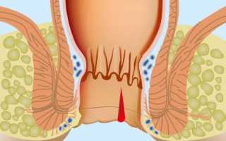 Причины появления крови после дефекации и методы лечения