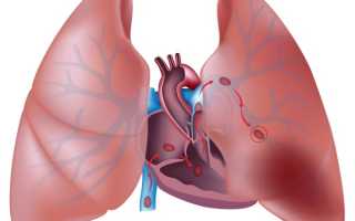 Что за болезнь такая тромбоэмболия легочной артерии, можно ли с ней жить