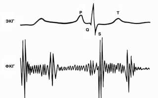 ФКГ сердца: суть метода, подготовка и расшифровка