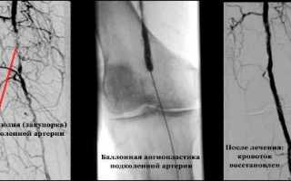 Непроходимость сосудов нижних конечностей: причины, симптомы и лечение