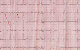Нарушение процессов реполяризации в миокарде: что это и как лечить