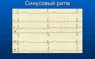 Синусовый ритм сердца: особенности и норма