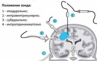 Как измеряют внутричерепное давление у взрослых и ребенка