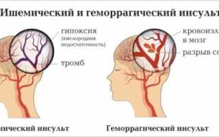 При каком давлении возможно развитие инсульта